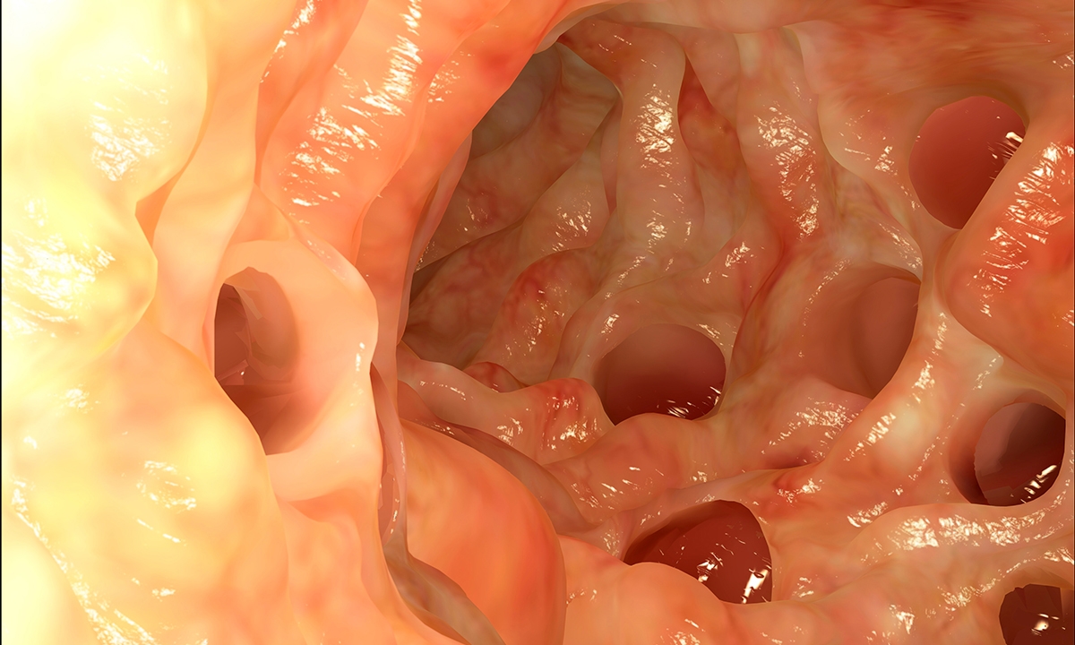 Uncomplicated diverticulitis putting antibiotics on hold 885