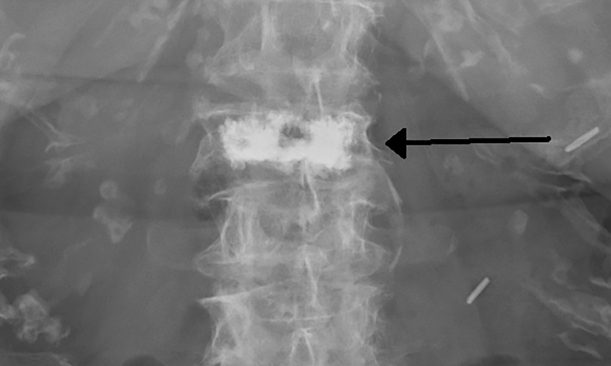 Vertebroplasty back from the dead 493