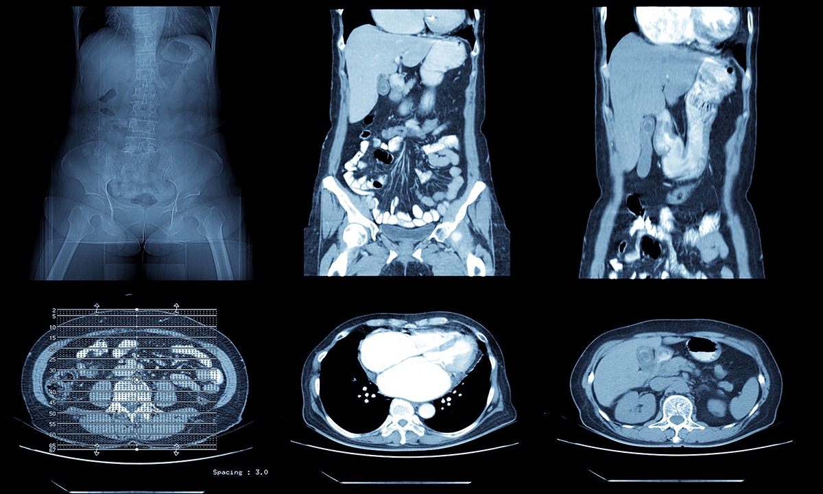 Virtual colonoscopy could ease bowel cancer wait lists 522