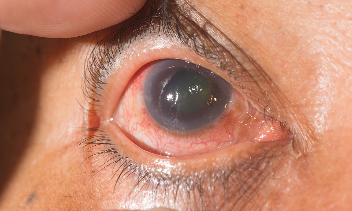 What gps can do to boost glaucoma diagnosis rates 558