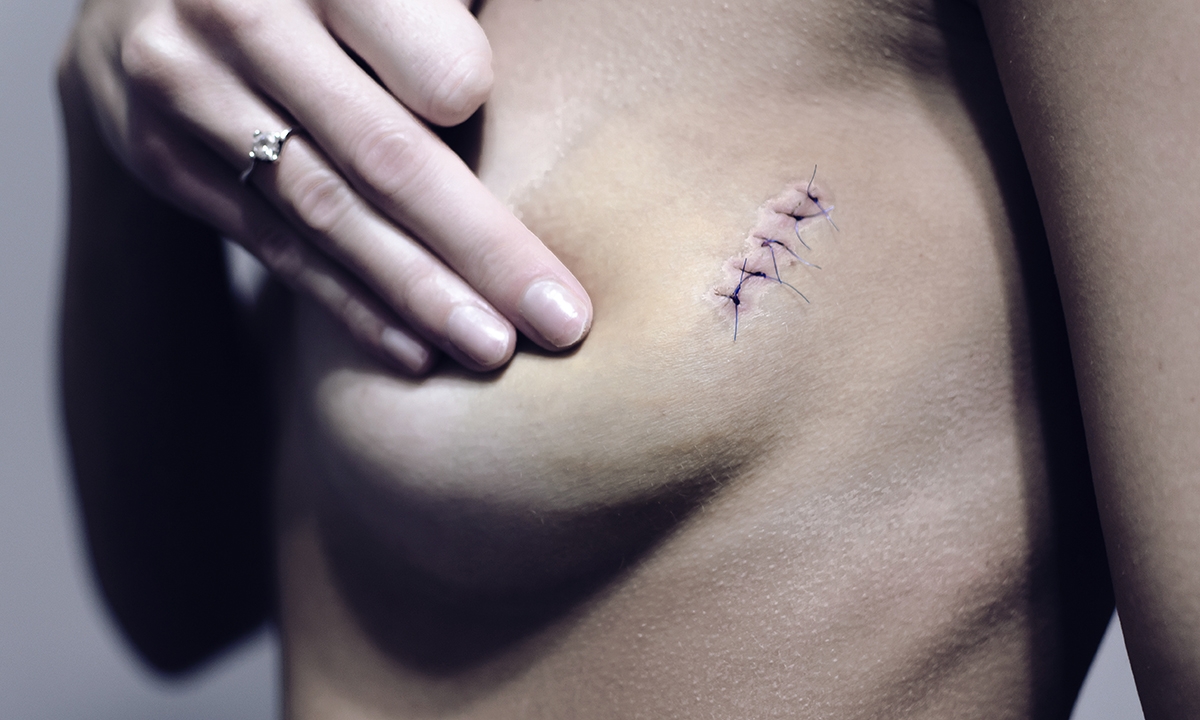 What happens to breast cancer survivors 767
