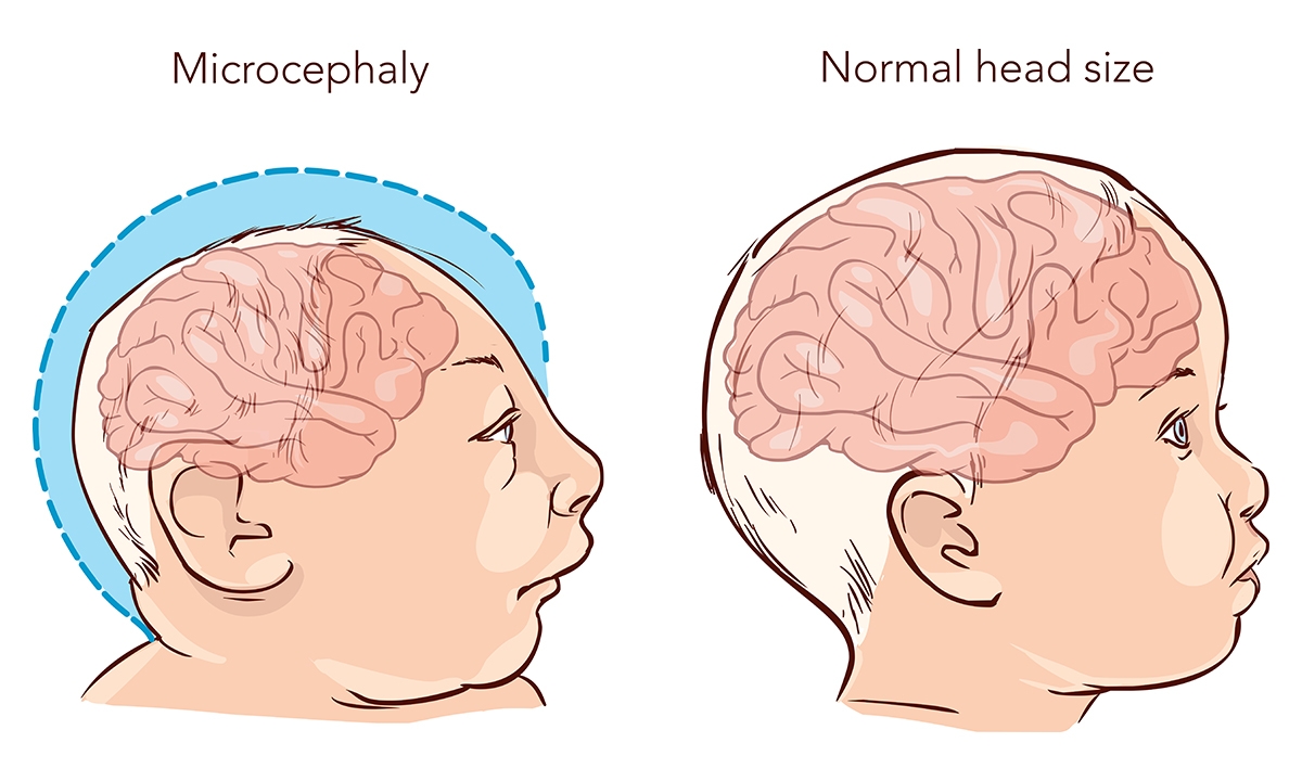 Zika prep confirms microcephaly and FASD link - Featured Image