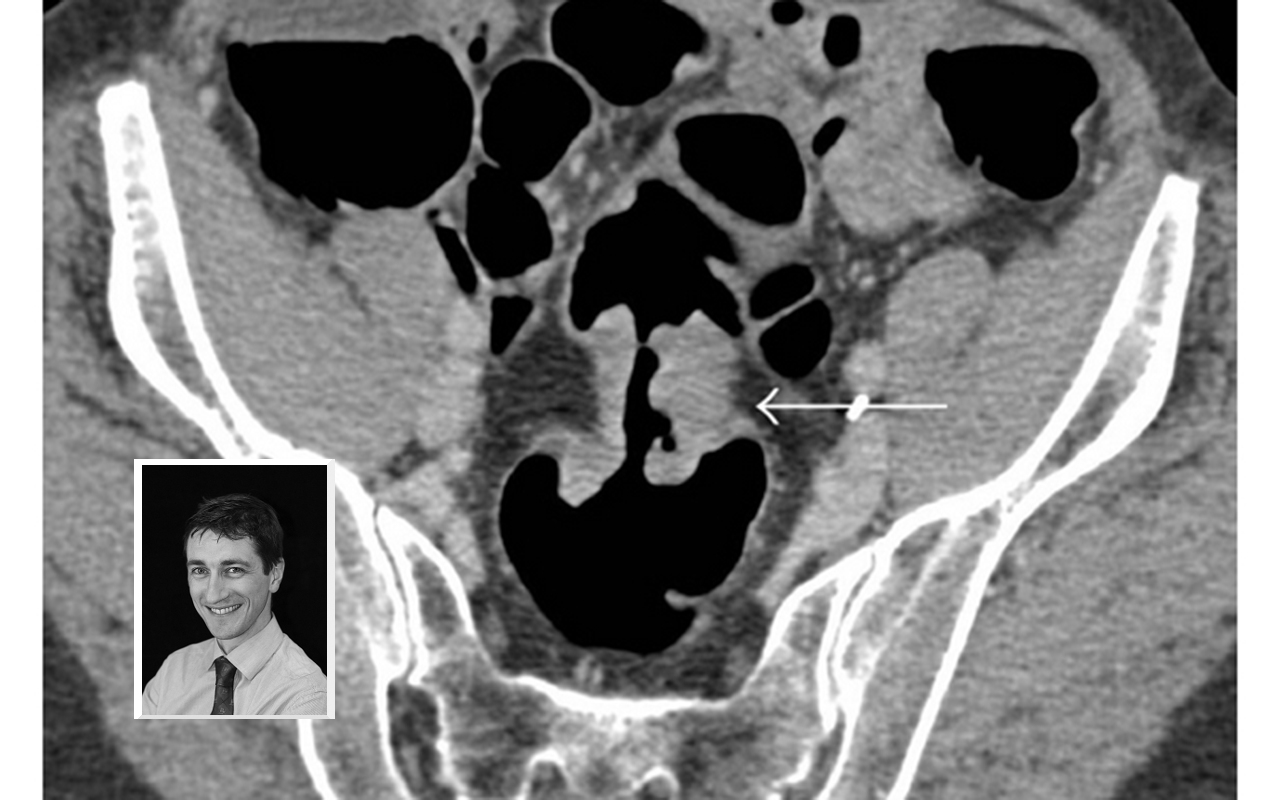 Virtual colonoscopy, with Prof Tom Sutherland