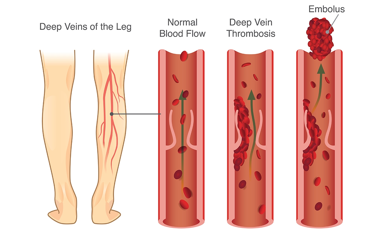 Deep vein thrombosis, with Dr Paul Kruger