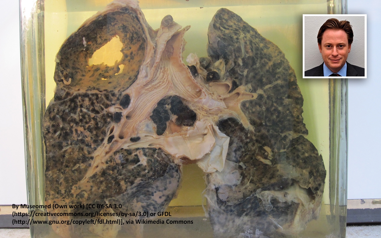 Occupational lung diseases, with Dr Ryan Hoy