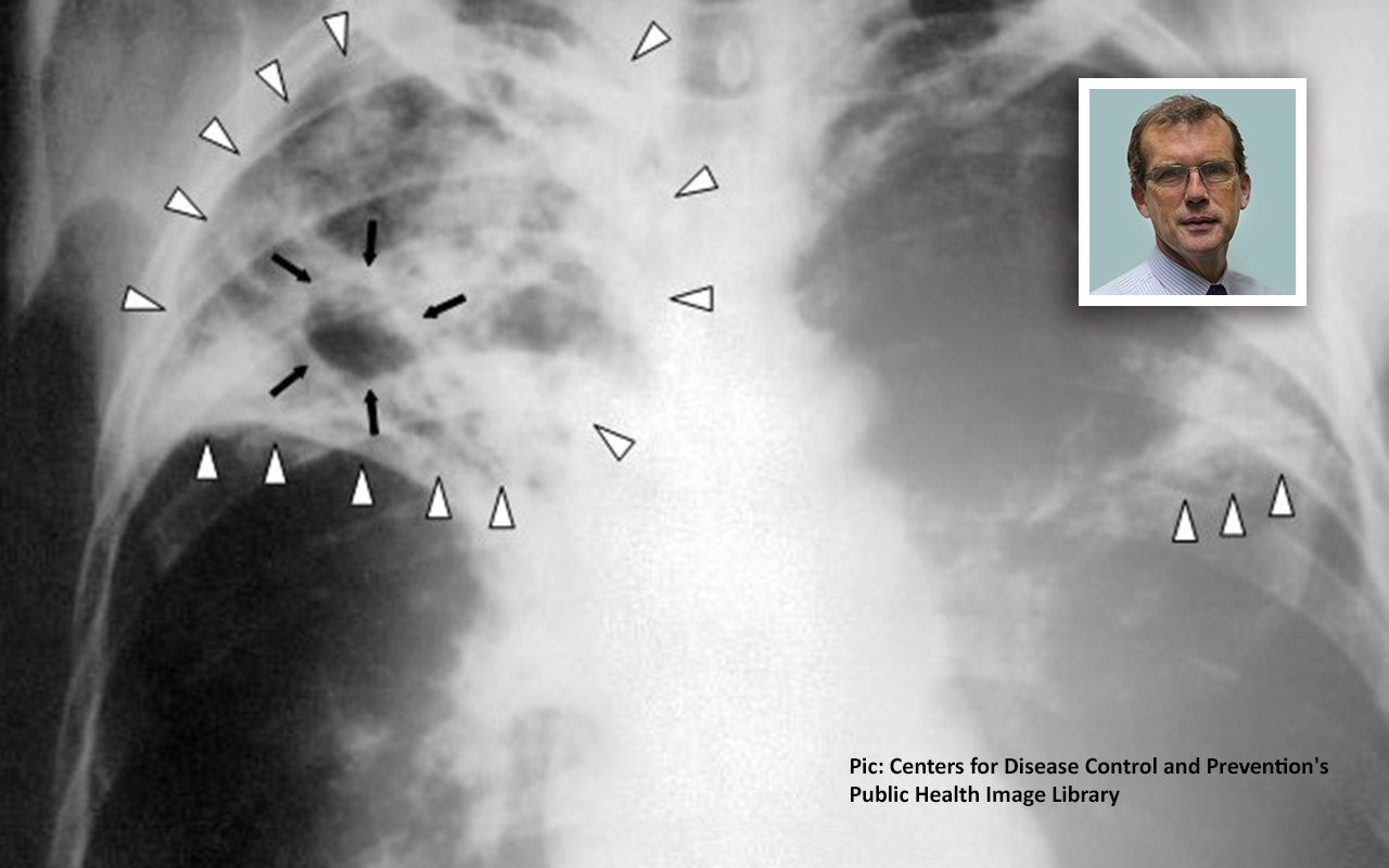 Lung health: the good and the bad news, with Prof Matthew Peters