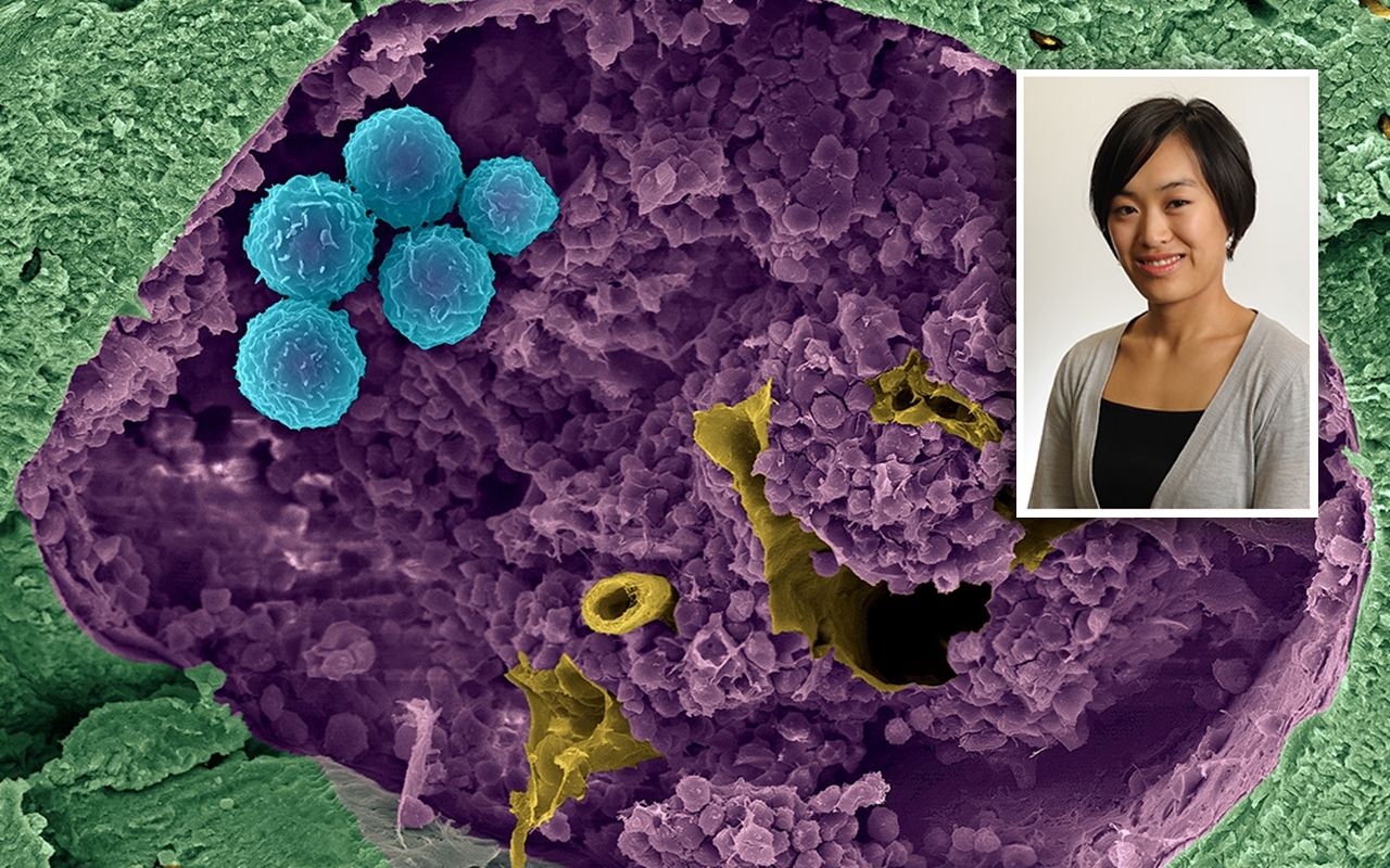Child stem cell donors, with Dr Shih-Ning Then