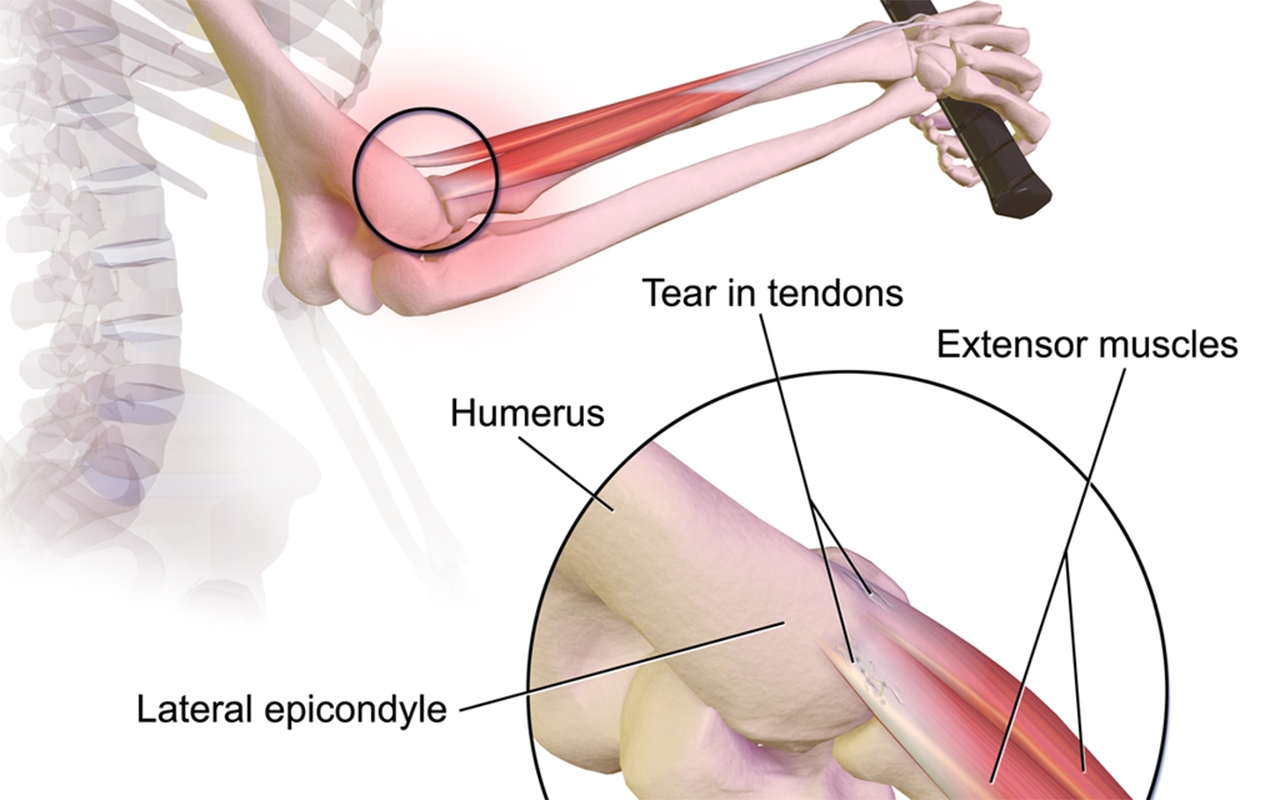 Tennis Elbow