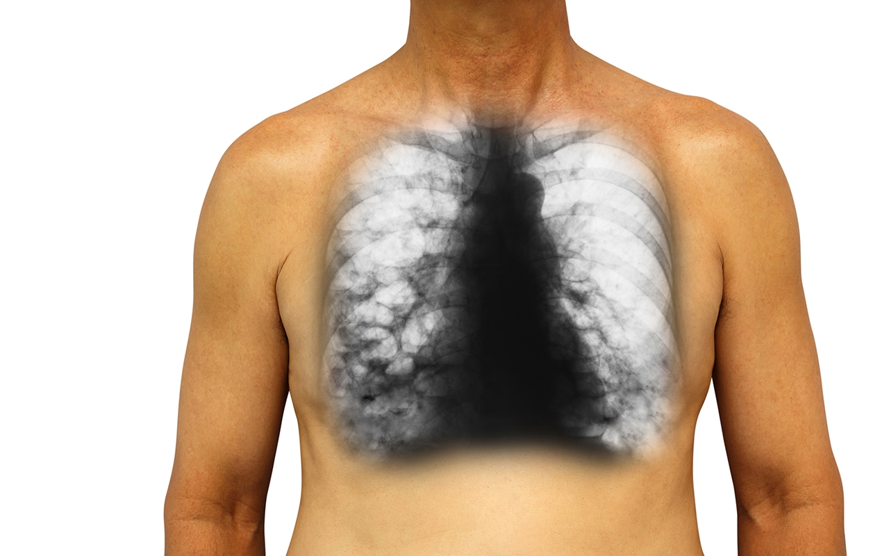 Bronchiectasis, with Dr Simone Visser and A/Prof Lucy Morgan