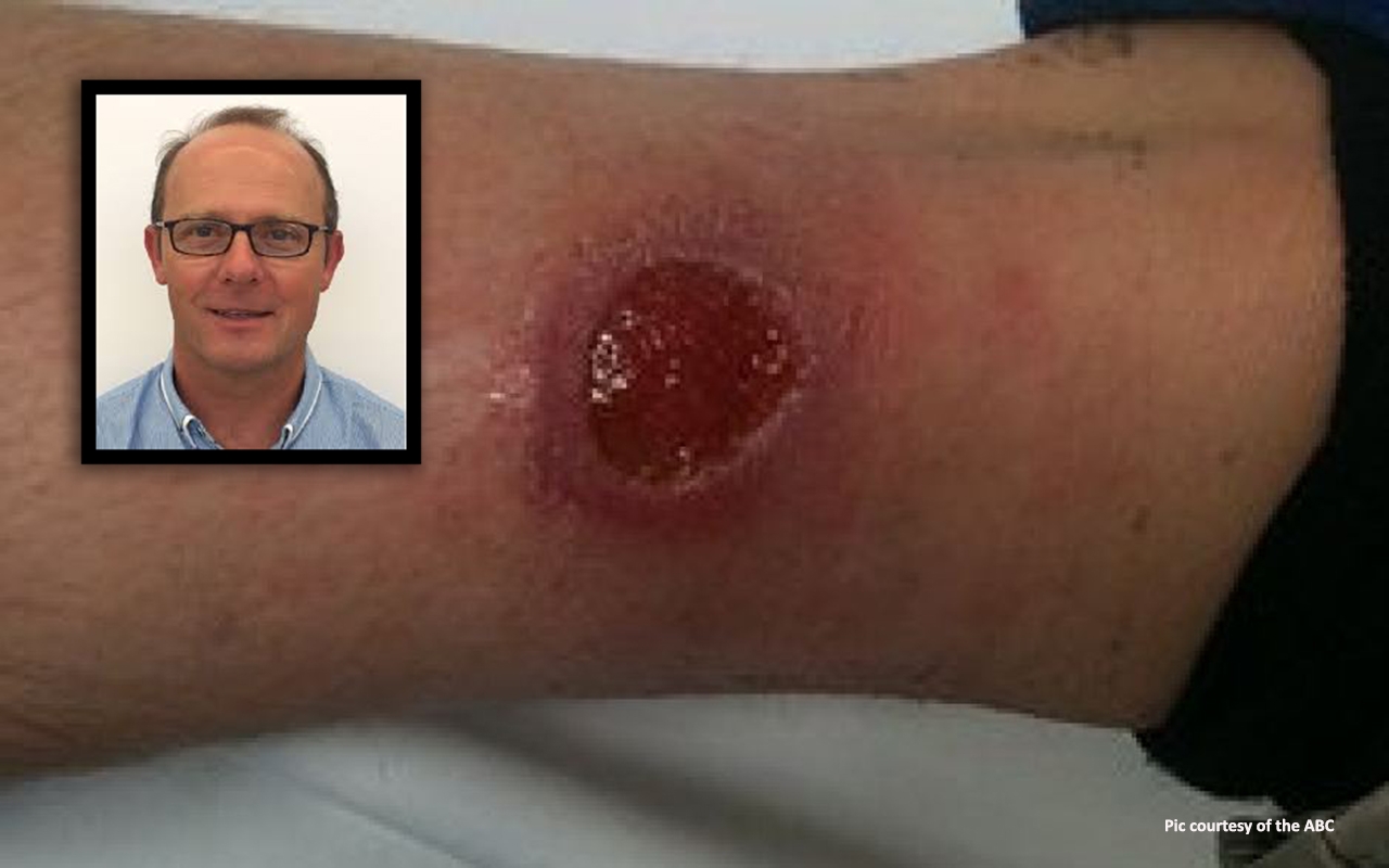 Pitfalls diagnosing Buruli ulcer, with A/Prof Daniel O'Brien