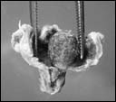 Opened appendix