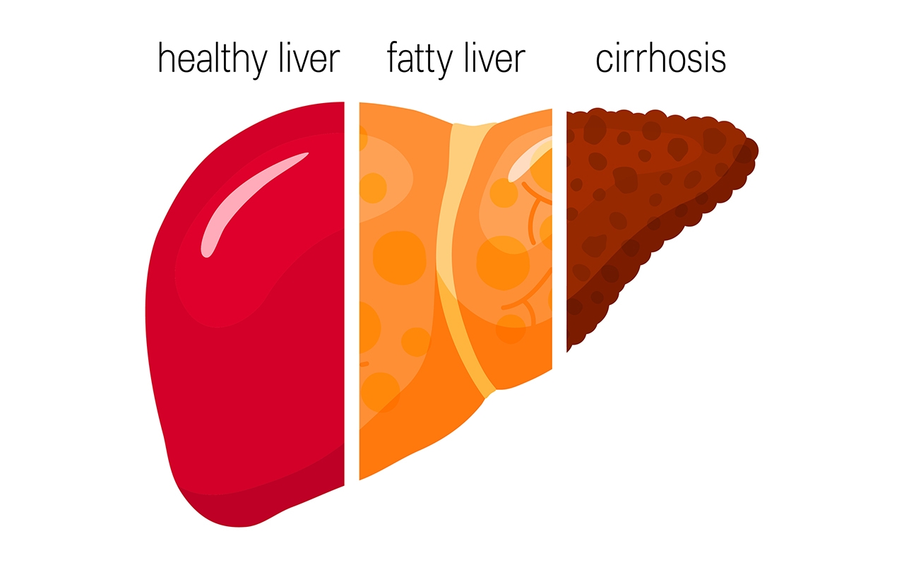 Cirrhosis20podcast