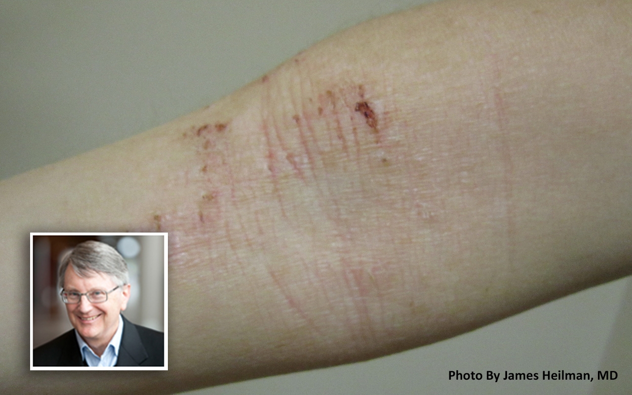 Atopic dermatitis, with Prof Alan Cooper