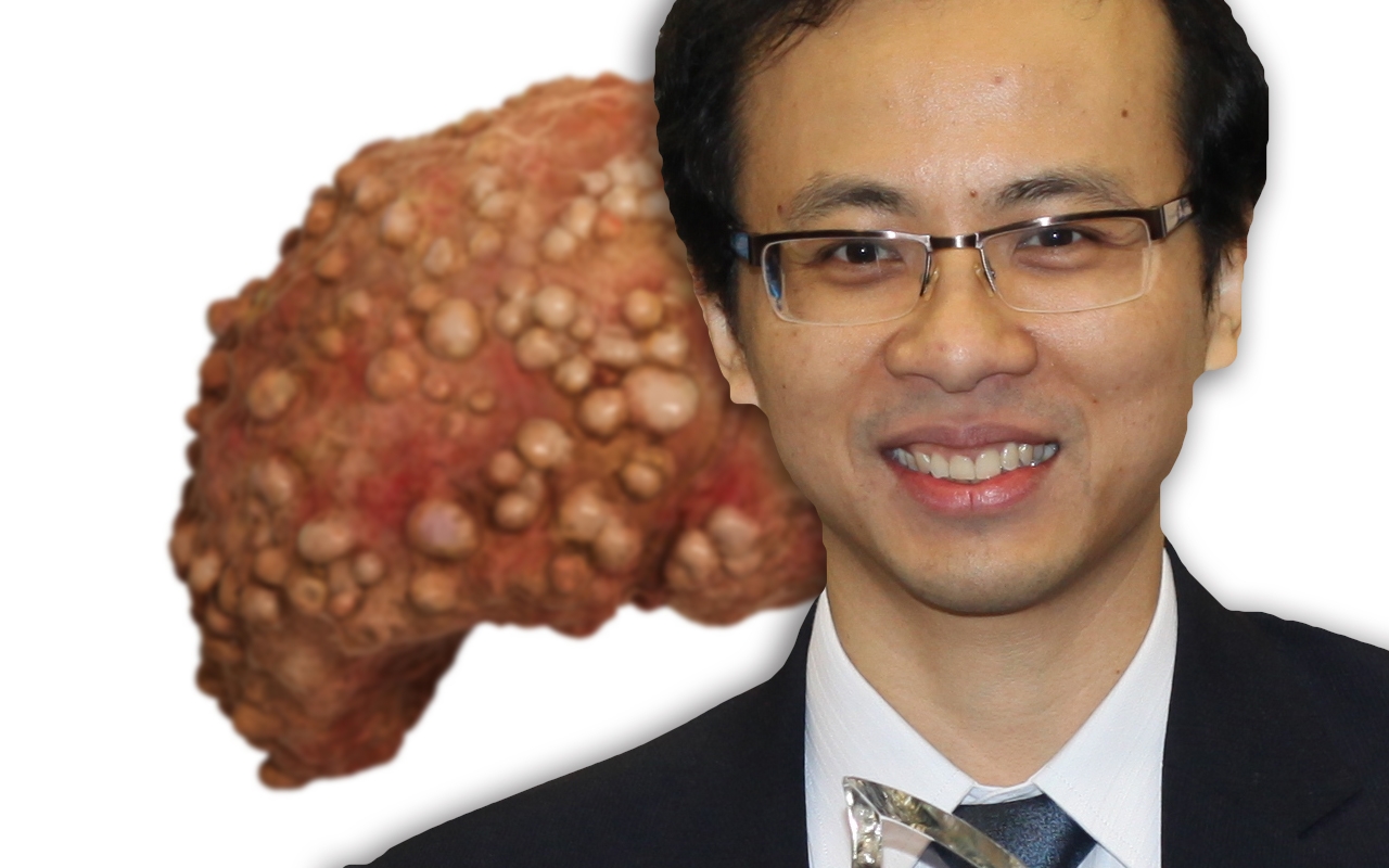Hepatocellular carcinoma, with Dr Thai Hong