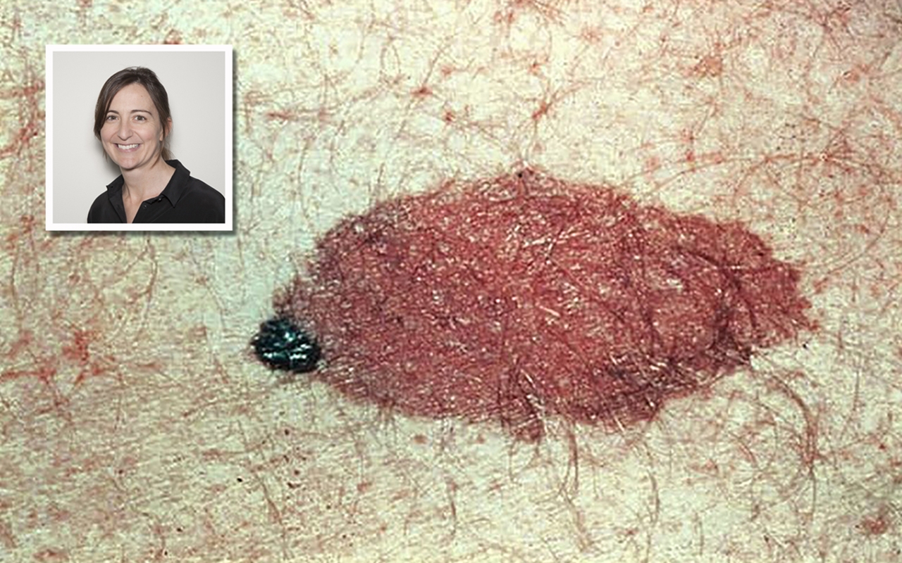 Atypical melanomas, with Dr Victoria Mar