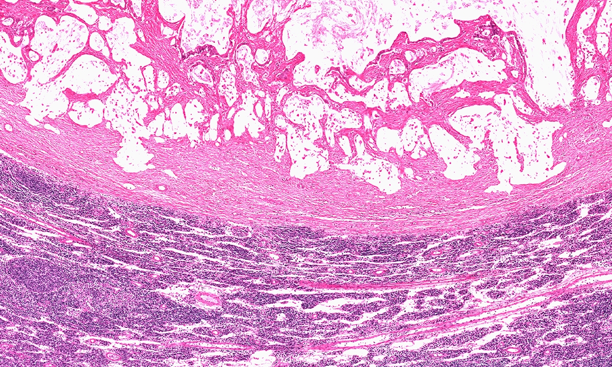 Mja2 51424