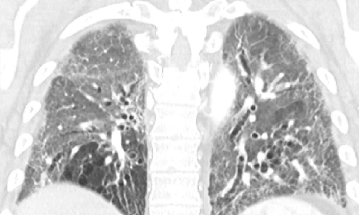 Mja2 52597
