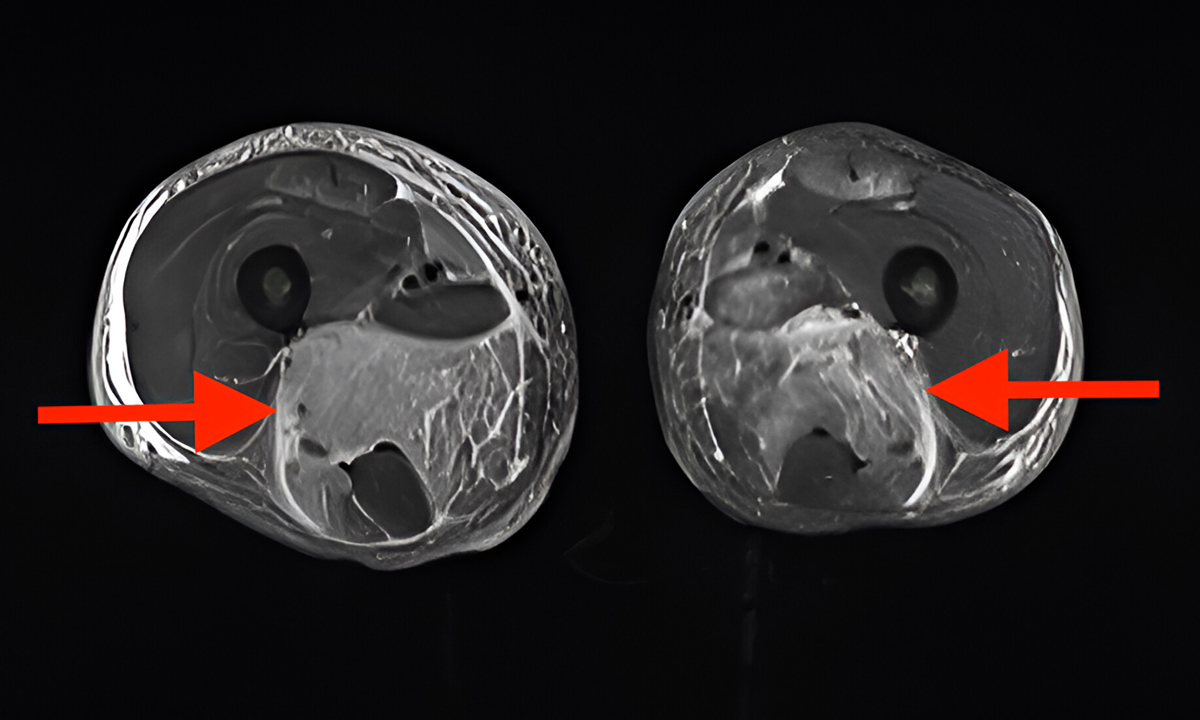 Rhabdomyolysis After COVID-19