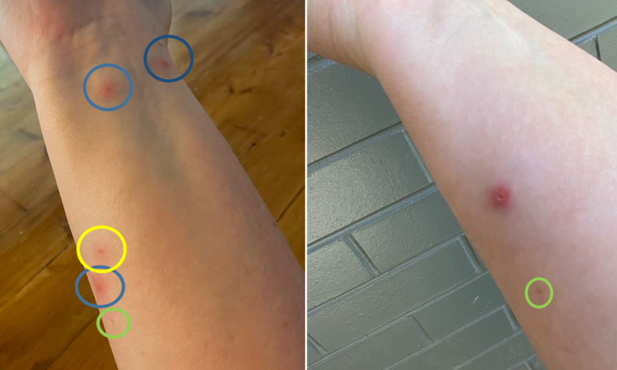 Buruli Ulcer Acquired From Ringtail Possum Rescue