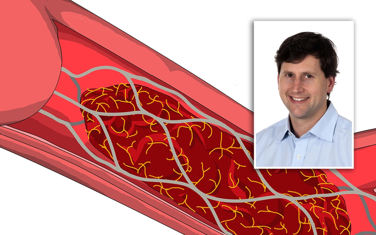 Advances in stroke medicine, with Professor Bruce Campbell