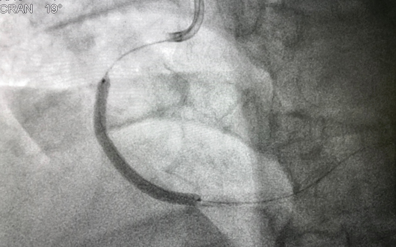 Ambulance travel and reperfusion after STEMI, with Dr Elly Redwood and Prof David Brieger