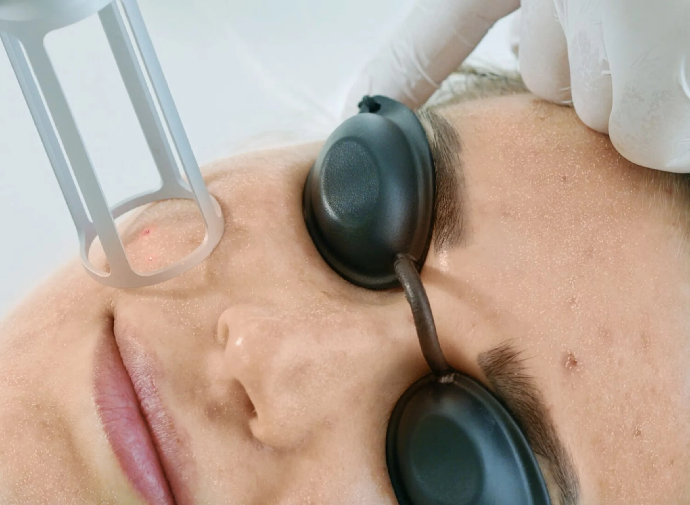In diesem Bild erkennt man wie die neue Dermatologin in Wien, Dr. Alica Píšteková eine Laserbehandlung im Gesicht durchgeführt.