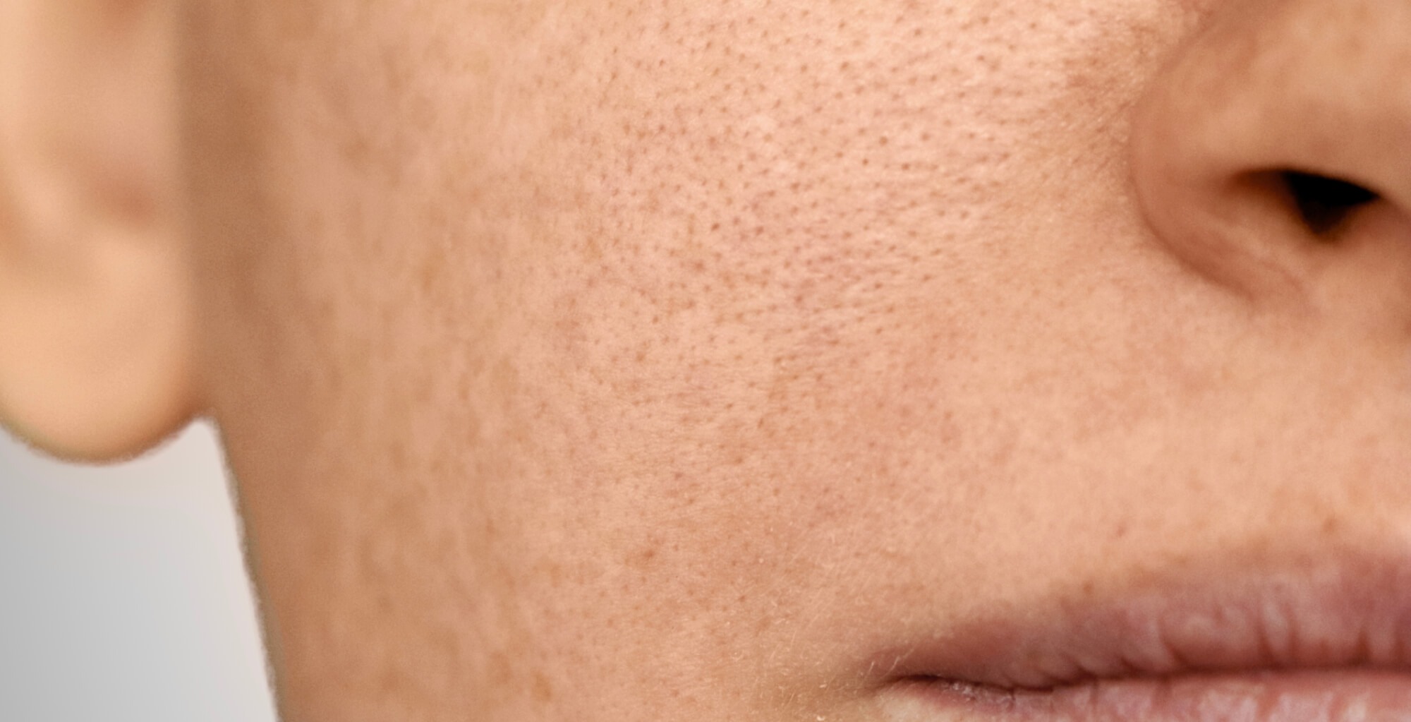 Auf dem Bild sieht man erneut leicht pigmentierte Gesichtshaut, womöglich durch Sonneneinstrahlungen im Sommer. Wie man Pigmentflecken loswerden kann, erfährst du am besten von Dermacares Experten.