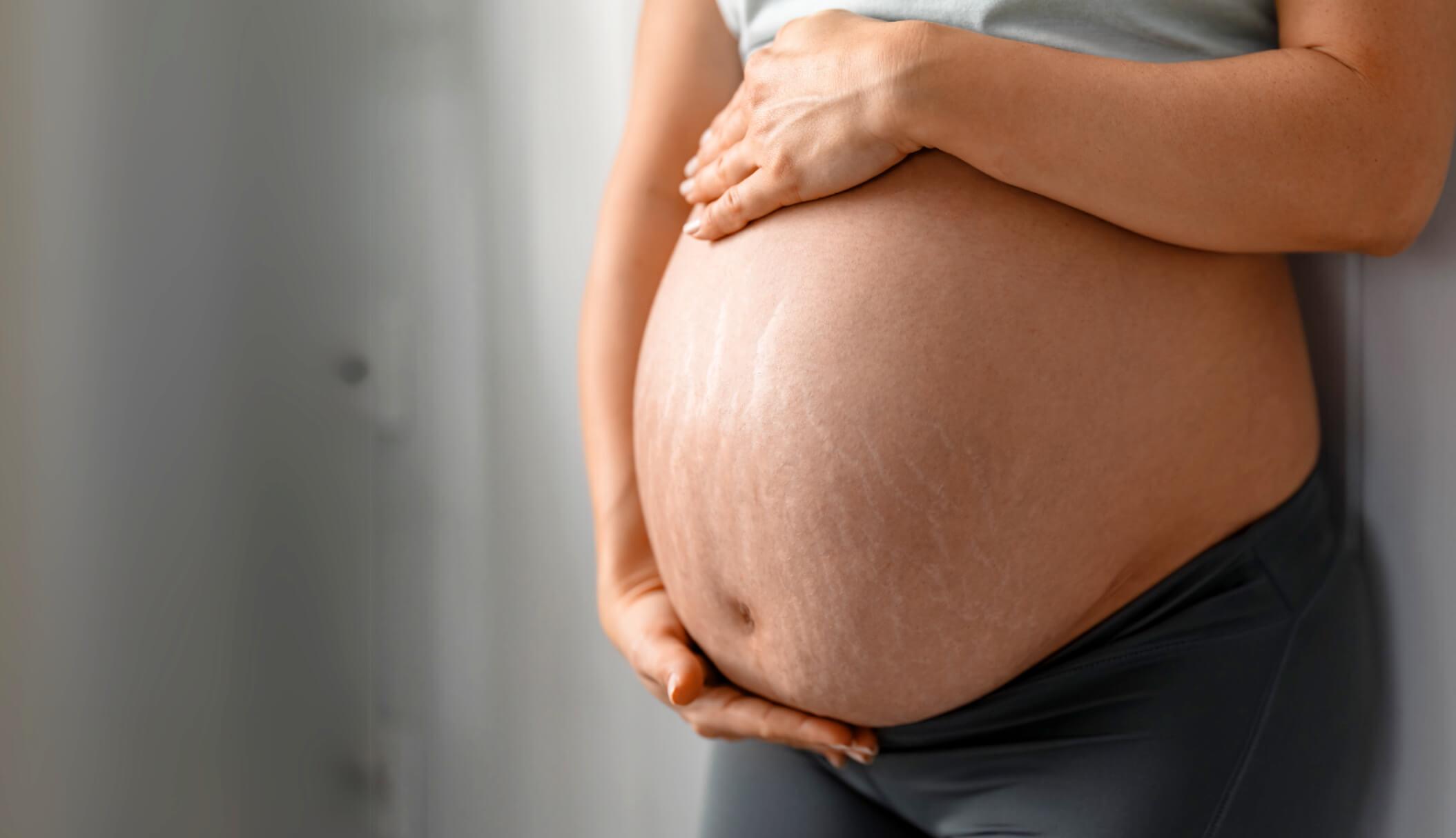 Auf dem Bild sieht man den Bauch einer schwangeren Frau, der deutlich sichtbare Schwangerschaftsstreifen am Bauch zeigt. Die feinen, hellen Linien sind typische Dehnungsstreifen durch Schwangerschaft, die durch das schnelle Dehnen der Haut entstehen. Viele Frauen wünschen sich nach der Geburt, diese Schwangerschaftsstreifen entfernen zu lassen – etwa durch moderne Behandlungen bei Dermacare in Wien.