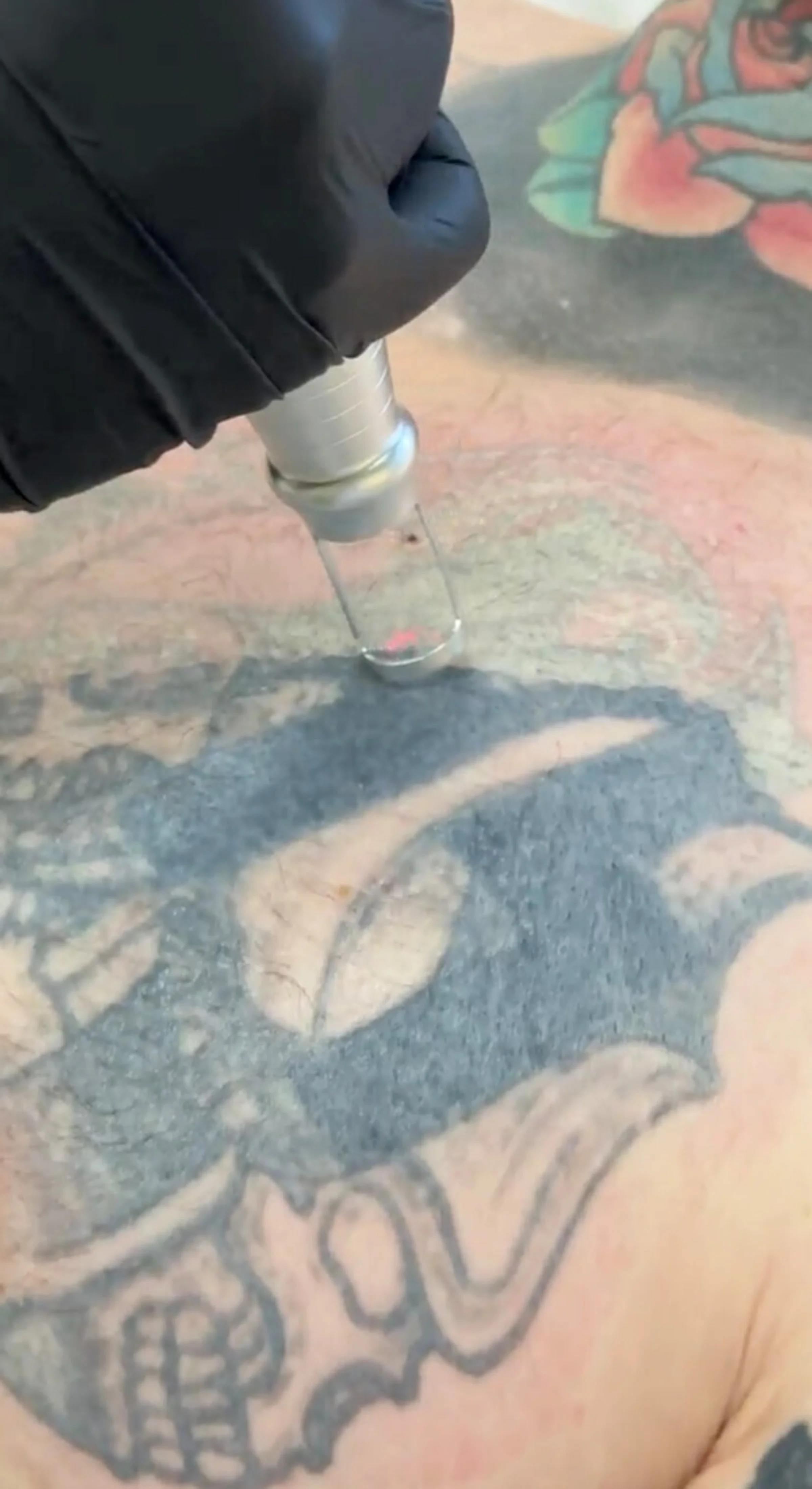 Hier ist die Tattooentfernung mittels Laser bei Dermacare Wien gut sichtbar. Könnte man dieses Tattoo überstehen? Wahrscheinlich schon, doch der Patient hat sich gegen das Cover-up und gleich für das weglasern entschieden.