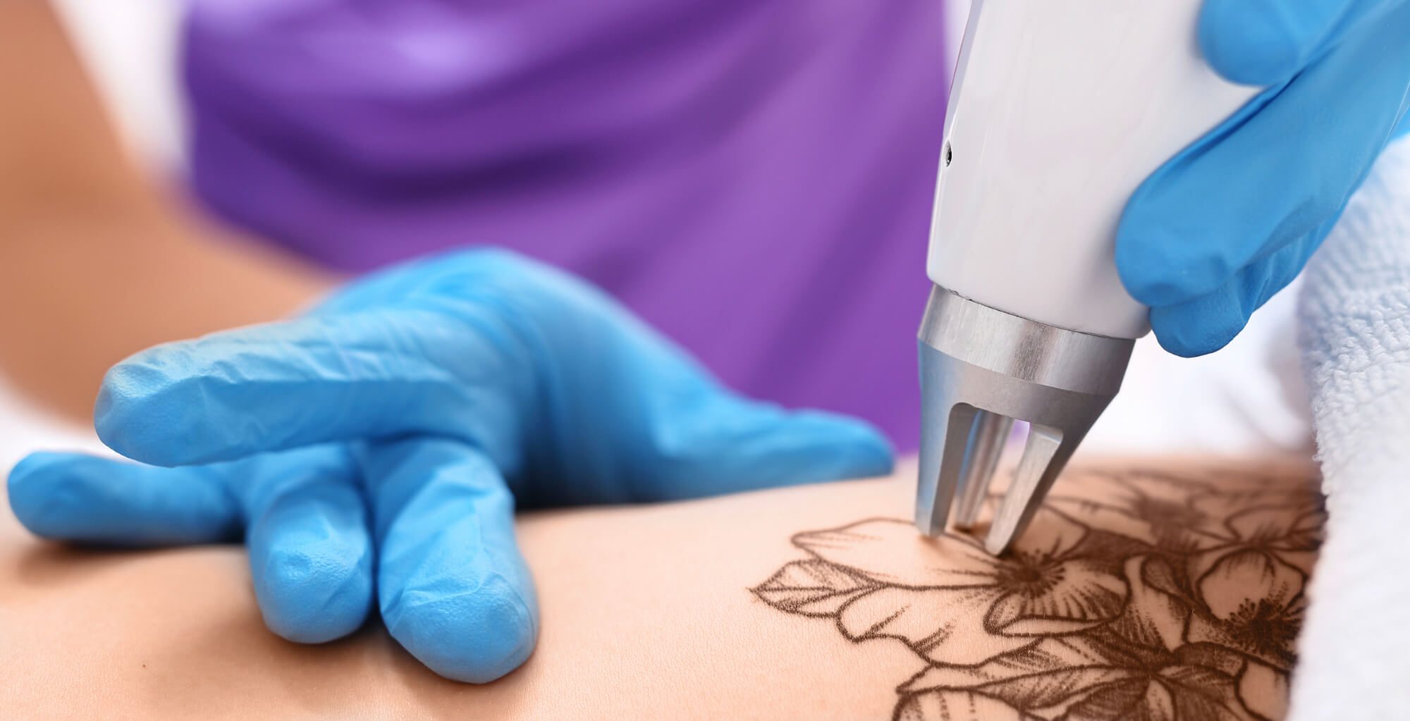 Tattoo entfernen – welche Methoden zur Tattooentfernung wirken?