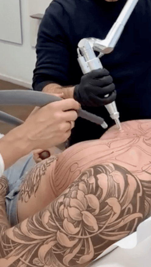 Auf dem Bild sieht man eine Behandlung bei Dermacare Wien. Der Patient wollte auf der Brust ein Tattoo weglasern lassen.