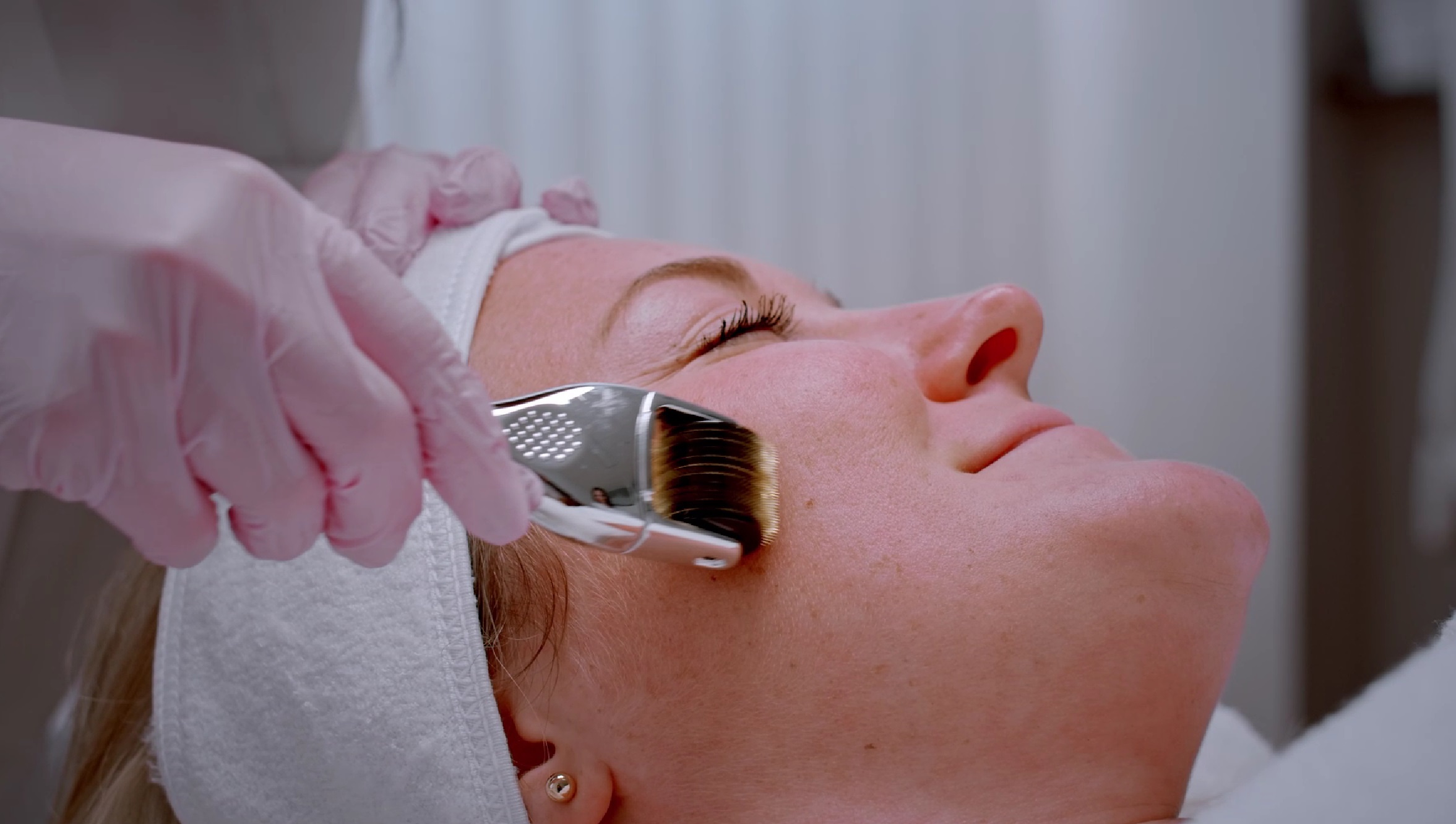 Microneedling Wien Dermaroller Behandlung bei Dermacare