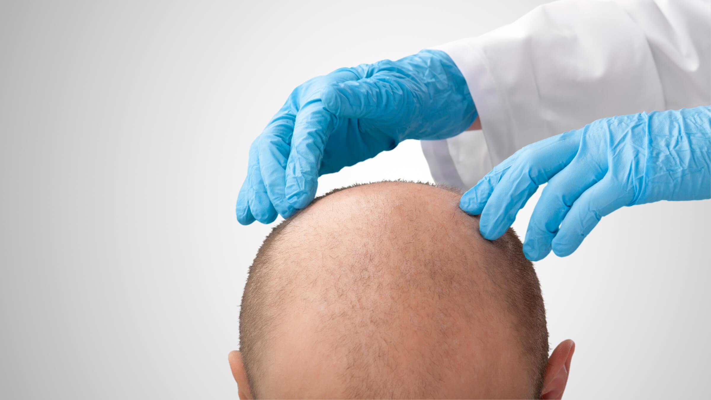 Das Bild zeigt einen Mann mit kahler Kopfhaut, der von einem Arzt mit blauen Handschuhen untersucht wird. Diese Darstellung verdeutlicht die Problematik des Haarausfalls und die Notwendigkeit von Haartransplantationen. Haarverpflanzung in Ungarn bietet eine kostengünstige und professionelle Lösung, da das Land für seine fortschrittlichen medizinischen Dienstleistungen bekannt ist.