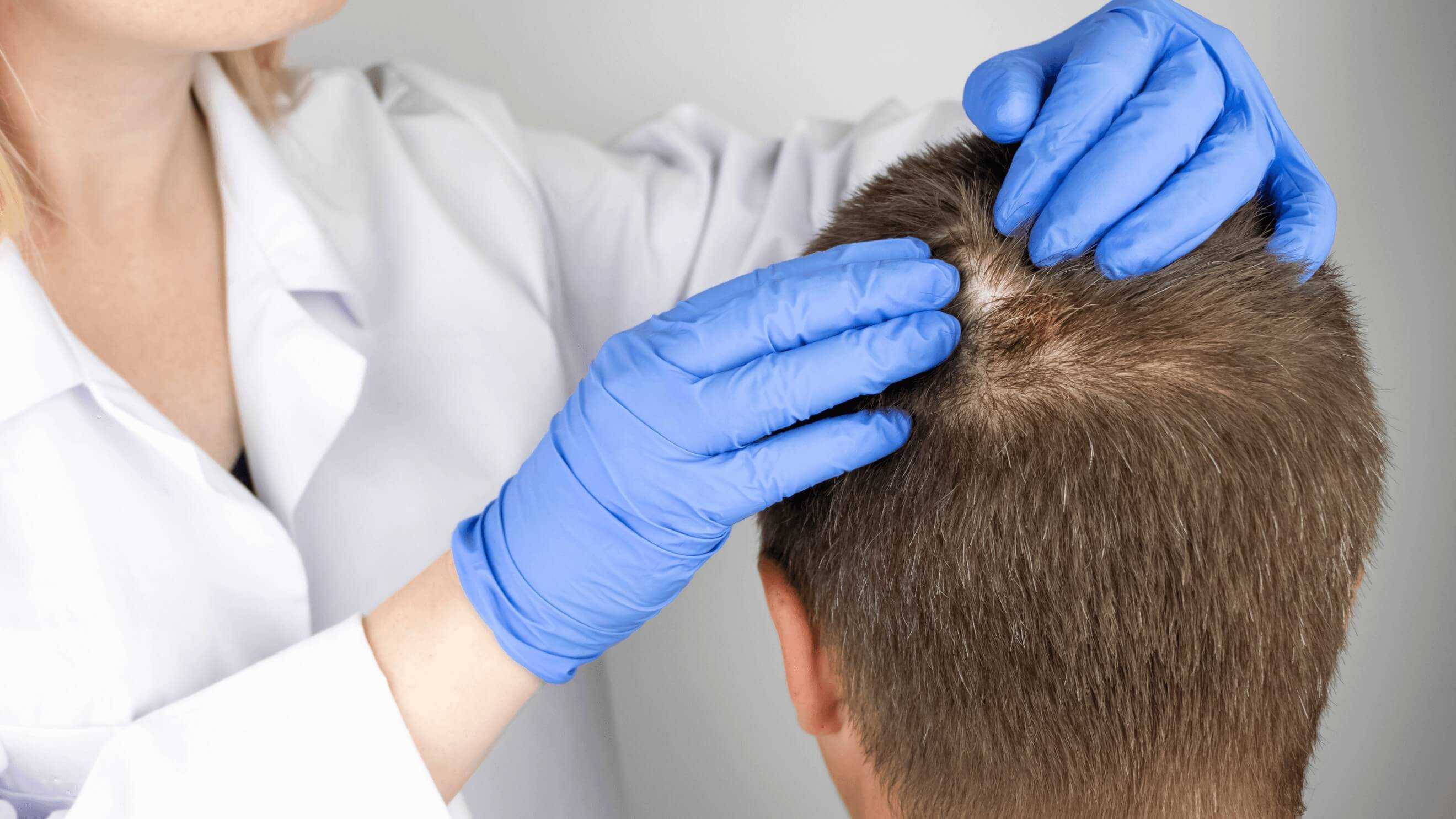 Das Bild zeigt eine Person, die von einem Mediziner in einem kosmetischen Institut untersucht wird. Der Mediziner trägt blaue Einweghandschuhe und hebt das Haar des Patienten an, um die Kopfhaut zu untersuchen. Dies deutet darauf hin, dass eine Haarverpflanzung in Wien vorbereitet oder überprüft wird. Der Fokus liegt auf dem Bereich der Kopfhaut, wo möglicherweise eine Haartransplantation durchgeführt wurde oder geplant ist. Die Szene vermittelt ein professionelles und hygienisches Umfeld, wie es für eine Haarverpflanzung bei Dermacare Wien typisch ist.