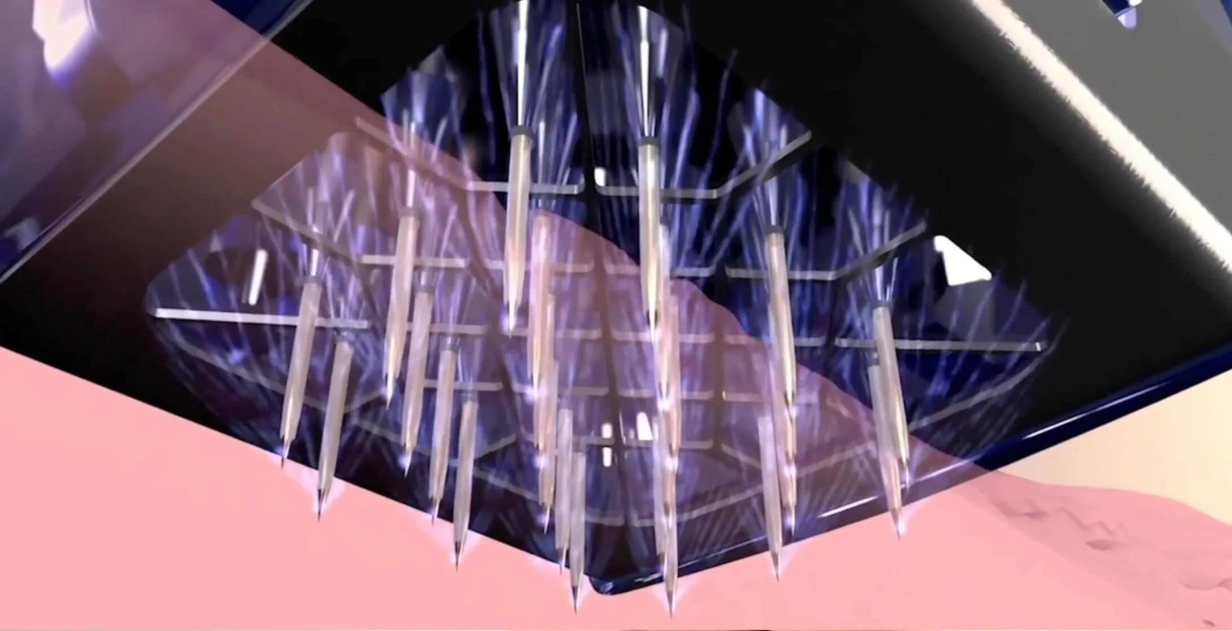 Dieses Bild zeigt die Unterseite des Applikators mit den Morpheus8 Mikronadeln, die durch ein feines Raster präzise in die Haut eingebracht werden. Dank der integrierten Vakuumtechnologie wird das zu behandelnde Hautareal sanft angesaugt, so können die Nadeln mit gleichmäßigem Druck und exakter Tiefe in die Haut eindringen. Gleichzeitig wird Radiofrequenzenergie in das Gewebe geleitet, um die Regeneration der Haut in der Tiefe zu fördern.
Die Vakuumunterstützung sorgt nicht nur für mehr Komfort, sondern auch für gleichmäßige Behandlungsergebnisse, selbst in sensiblen Bereichen wie Gesicht, Hals oder Dekolleté.