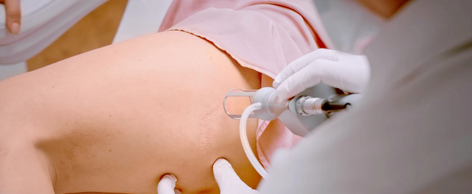Auf dem Bild ist eine Patientin während einer Narbenbehandlung mit Laser im Schönheitsinstitut Dermacare Wien zu sehen. Der behandelnde Spezialist trägt Handschuhe und setzt einen CO2 Laser gezielt an einer Hautstelle am Bein der Patientin an. Der Laser gibt feine, präzise Lichtimpulse ab, die das Narbengewebe schrittweise abtragen und die Hauterneuerung anregen. Die behandelnde Stelle zeigt eine leichte Aufhellung, was darauf hinweist, dass die Laserenergie das Gewebe bereits beeinflusst. Die Patientin liegt entspannt auf einer Behandlungsliege, während der Arzt die Behandlung präzise durchführt. Diese Methode des Narben laserns hilft, das Hautbild zu verbessern, Narben zu reduzieren und die natürliche Kollagenproduktion zu stimulieren, ohne das umliegende Gewebe zu schädigen.