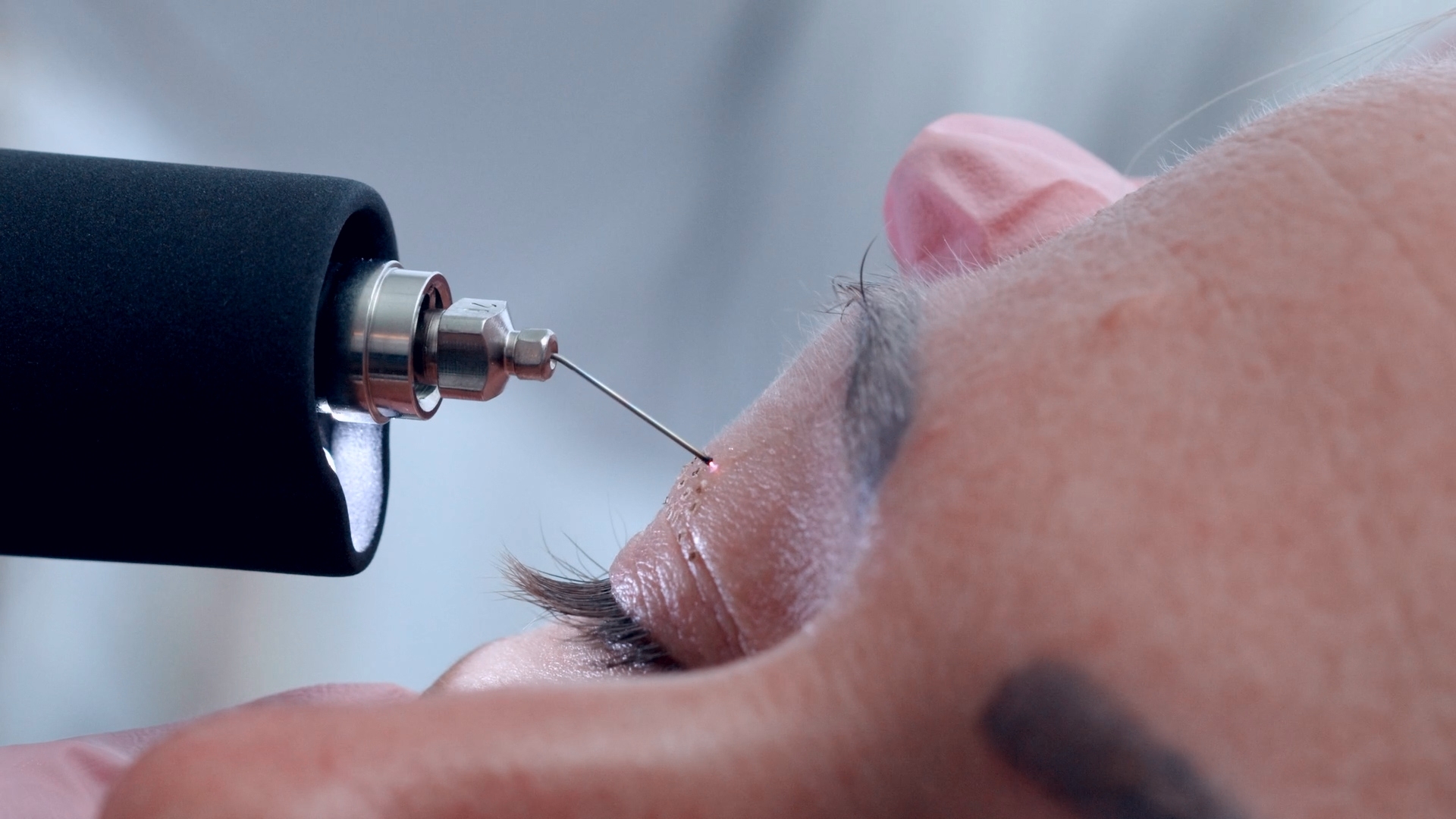 Plasmapen-Behandlung bei Dermacare Wien - Schluss mit hängenden Lidern