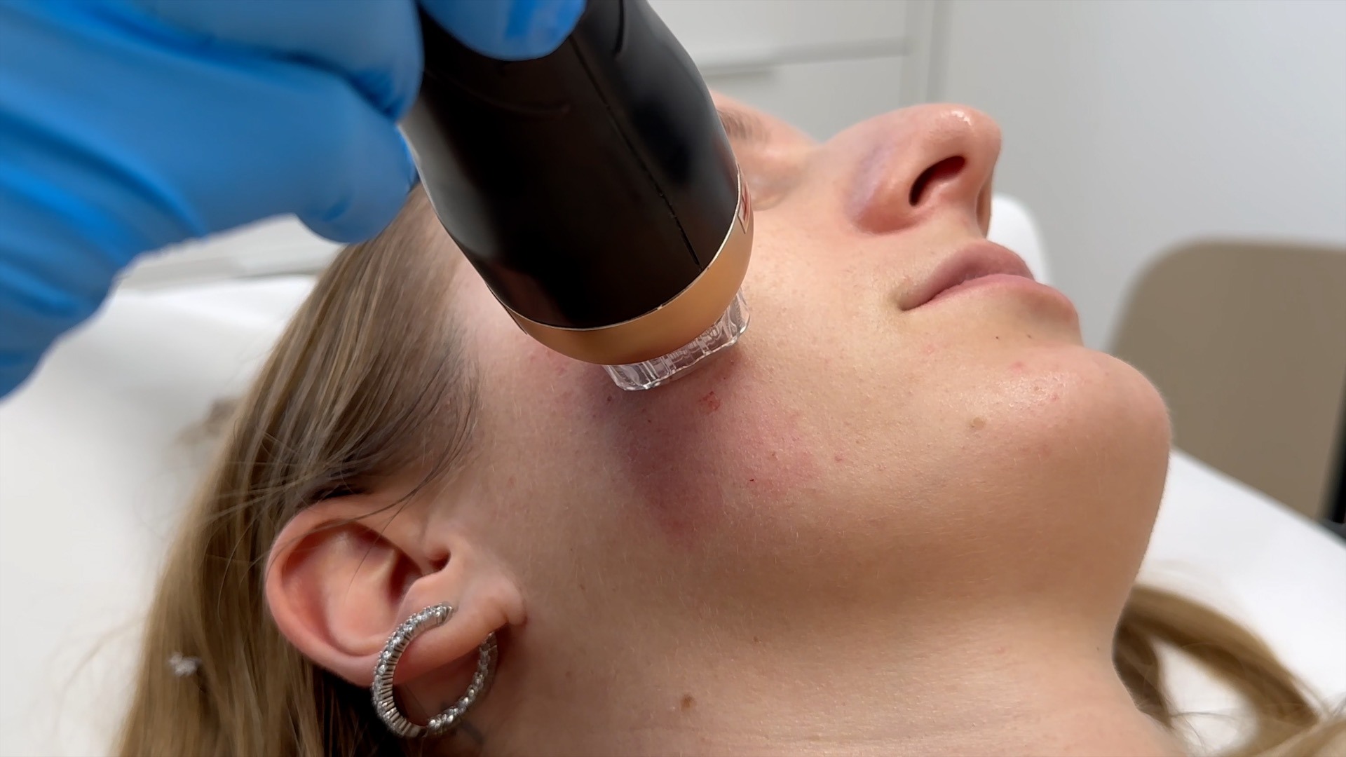 Das Bild zeigt eine Frau, die sich einer Radiofrequenz-Microneedling-Behandlung in Wien unterzieht. Ein professioneller Behandler, der blaue Handschuhe trägt, verwendet ein spezielles Gerät, um die Behandlung durchzuführen. Das Gerät, das in Nahaufnahme zu sehen ist, wird auf die Haut der Frau aufgesetzt und kombiniert feine Nadeln mit Radiofrequenzenergie. Diese Methode soll die Kollagenproduktion anregen, die Haut straffen und ihr ein jüngeres Aussehen verleihen. Die Behandlung findet in einer sauberen und professionellen Umgebung statt, was auf eine klinische oder medizinische Einrichtung hinweist. Radiofrequenz Microneedling Wien ist eine beliebte ästhetische Behandlung, um die Hautstruktur zu verbessern, Falten zu reduzieren und das allgemeine Hautbild zu verjüngen. Ebenso kann diese Behandlung mit Morpheus 8 verglichen werden.