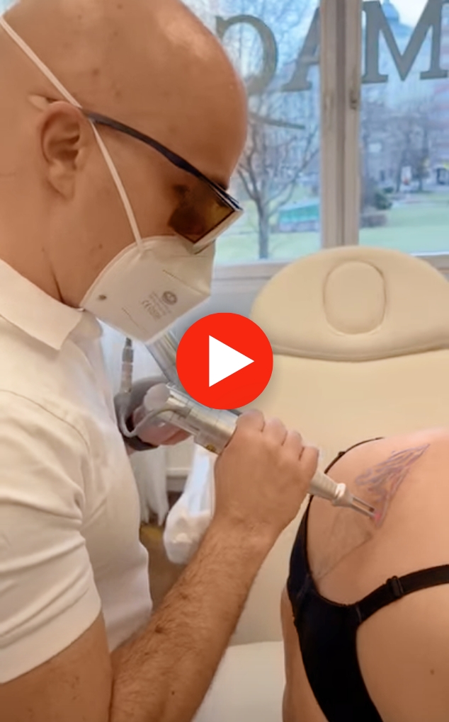 Auf dem Bild ist eine Laser Tattooentfernung von Dermacare Wien zu sehen. Einer Frau wird gerade ein Rückentattoo entfern.