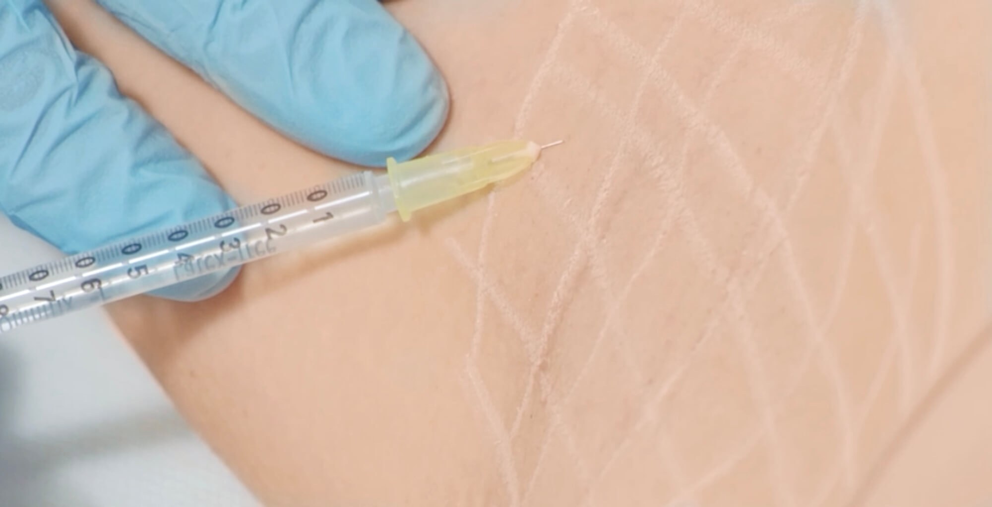 Präzise Botox-Injektion gegen starkes Schwitzen Zu sehen ist die Behandlung einer Achsel mit einer feinen Botox-Injektion. Die markierte Fläche zeigt, wie gezielt bei Dermacare Wien gearbeitet wird. Die minimalinvasive Methode blockiert die überaktive Schweißproduktion dort, wo sie entsteht – sanft, punktgenau und nahezu schmerzfrei. Wer sich fragt: Was hilft gegen Schwitzen? – für viele ist genau diese Behandlung die effektive Antwort.