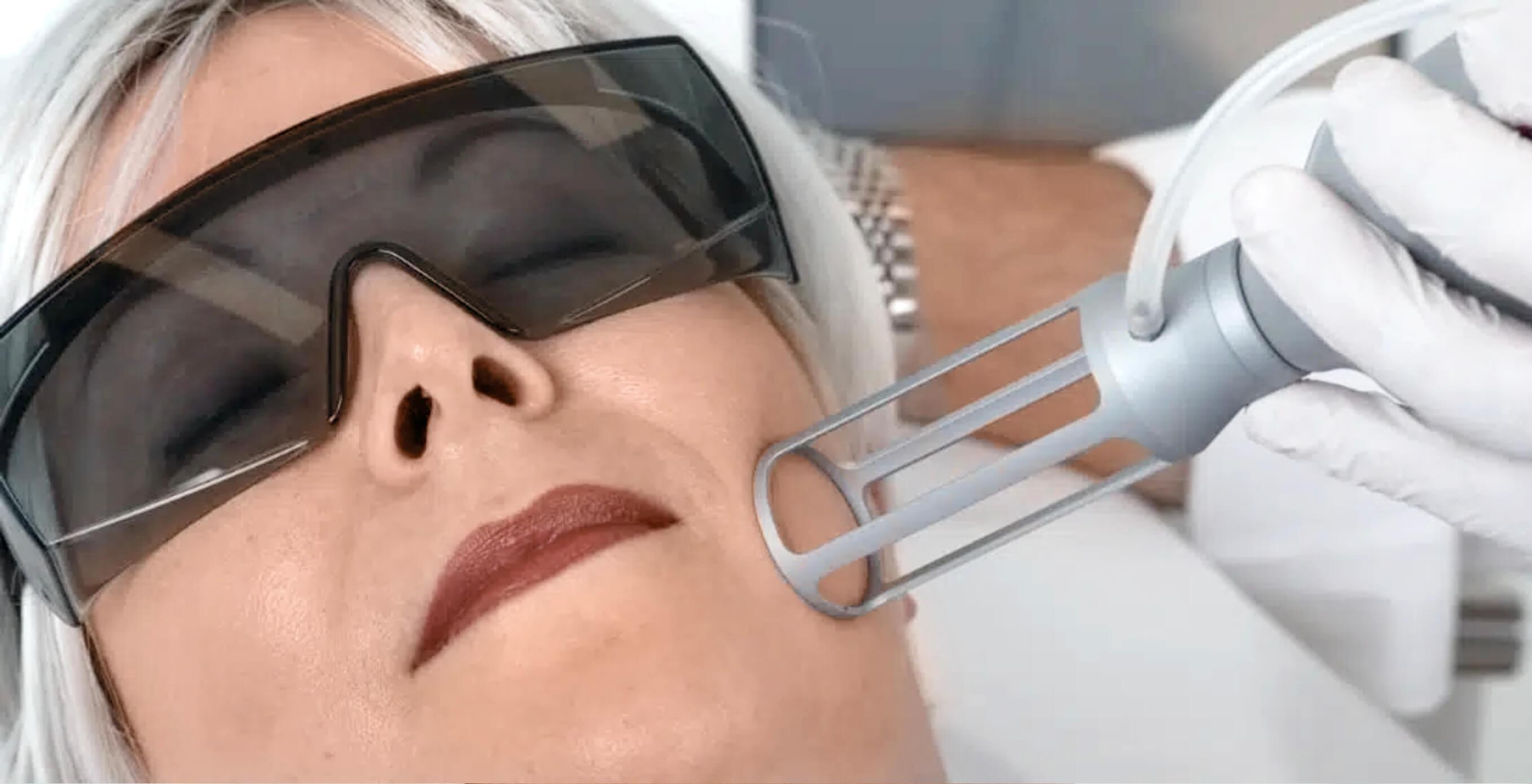 Auf diesem Bild sieht man wie Dermacare Wien einer Patientin aknenarben entfernen. Sie nutzen dabei einen hochmodernen Laser der an der betroffenen Stelle eingesetzt wird.