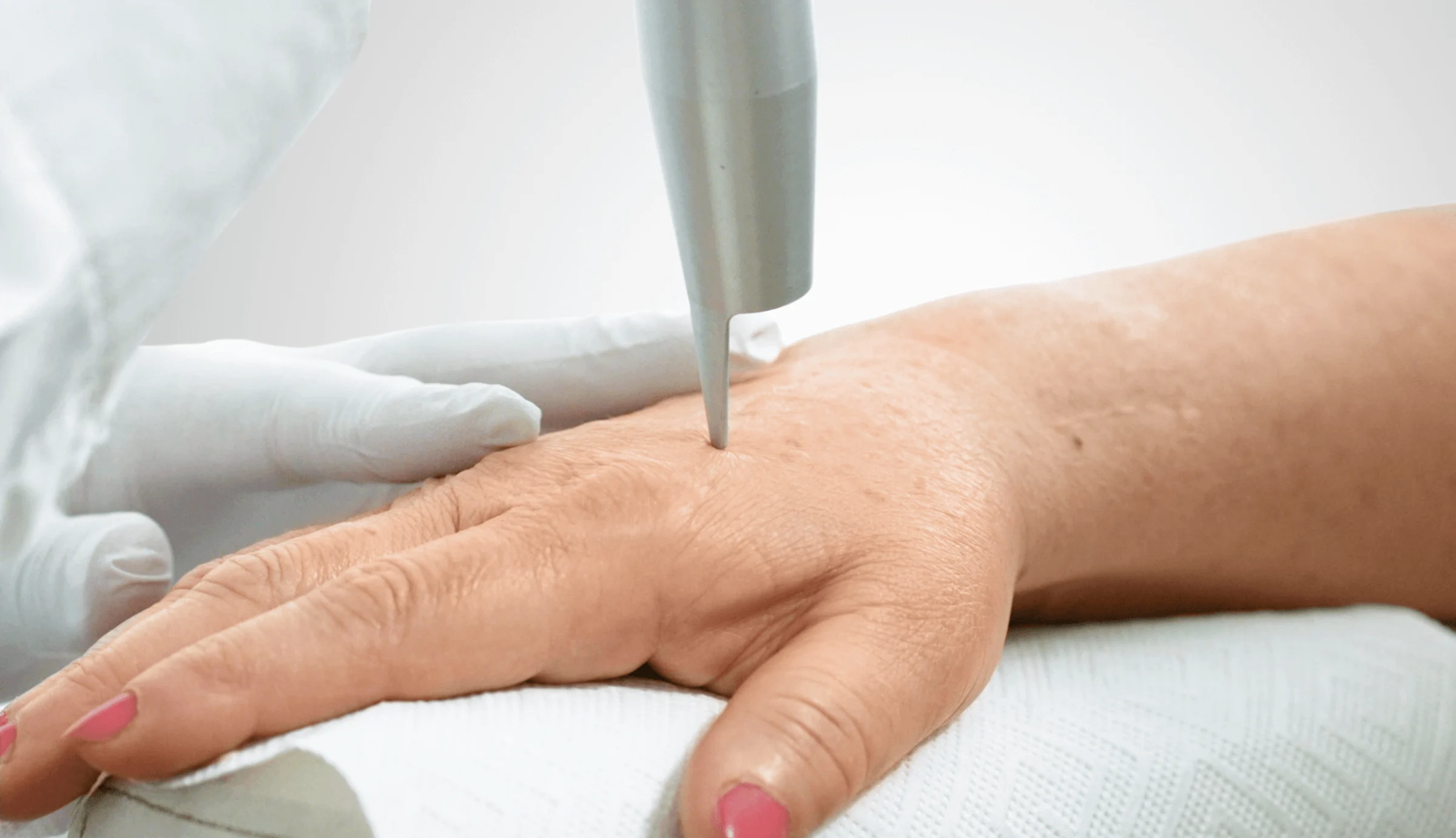 Das Bild zeigt eine Nahaufnahme einer Behandlung zur Entfernung von Altersflecken auf dem Handrücken. Ein medizinisches Gerät, ein CO2-Laser, wird präzise auf die Haut der Hand gerichtet, während ein Facharzt in weißen Handschuhen die Behandlung durchführt. Diese Methode ist eine effektive Lösung, zuum Altersflecken und auch Pickelmale entfernen, insbesondere auf empfindlichen Stellen wie den Händen und im Gesicht. Der CO2-Laser trägt gezielt pigmentierte Hautschichten ab, um die Haut zu glätten und Altersflecken zu reduzieren. Die Behandlung bietet eine moderne Antwort auf die Frage: „Was tun gegen Altersflecken auf dem Handrücken?“ und auch ebenso "Was sind Pickelmale und wie kann ich sie entfernen?".