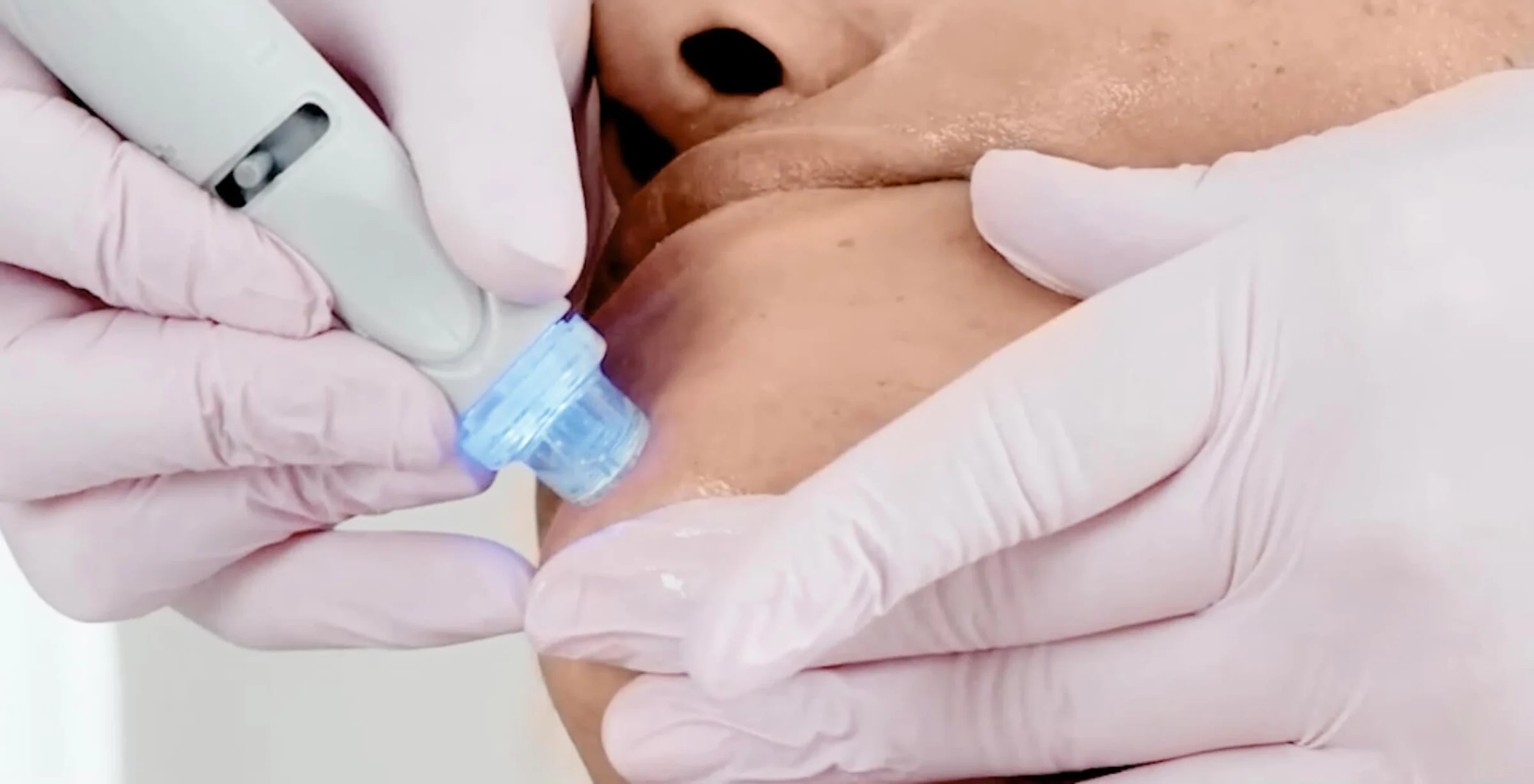 Nahaufnahme einer professionellen Aquafacial-Behandlung in Wien: Die Haut im Gesicht einer Frau wird schonend mit einem speziellen Handstück gereinigt und gepflegt, um Poren zu verfeinern und den Teint sichtbar zu erfrischen.