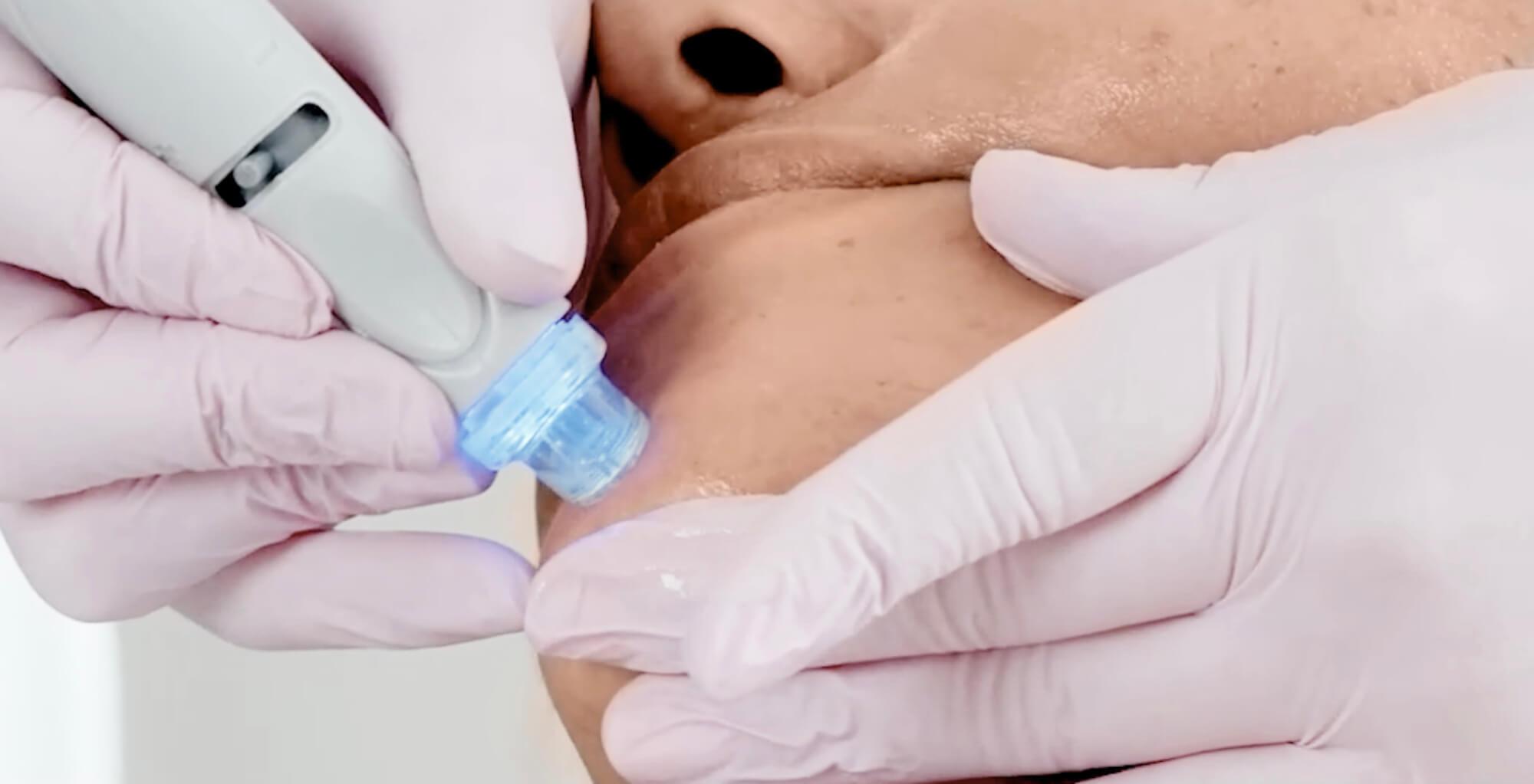Nahaufnahme einer professionellen Aquafacial-Behandlung in Wien: Die Haut im Gesicht einer Frau wird schonend mit einem speziellen Handstück gereinigt und gepflegt, um Poren zu verfeinern und den Teint sichtbar zu erfrischen.