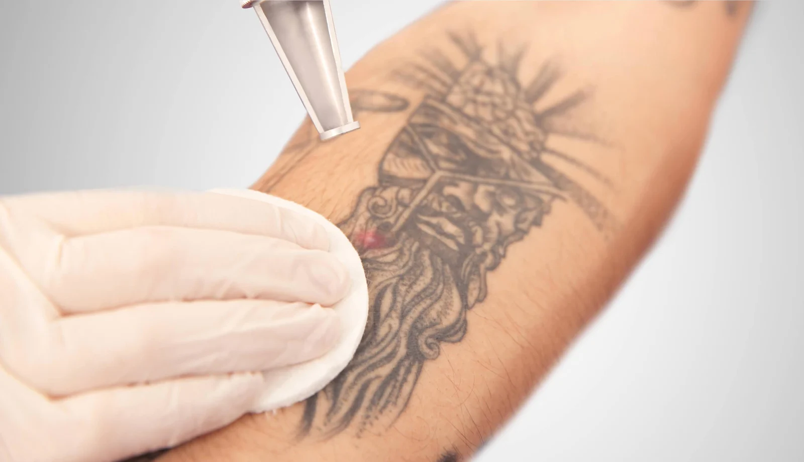 Das Bild zeigt die Cover Up Tattoo Vorbereitung bei Dermacare Wien. Hier wird ein Laser verwendet, um ein schwarzes Tattoo am Unterarm aufzuhellen. Das Motiv, das ein detailliertes Gesicht zeigt, wird mit einem speziellen Laser behandelt, während eine Person in Handschuhen vorsichtig die Stelle mit einem Wattepad reinigt. Diese Laserbehandlung ist der erste Schritt zur Vorbereitung eines neuen Cover Up Tattoos. Durch das Aufhellen der dunklen Bereiche wird die Grundlage für ein präziseres und klareres neues Tattoo-Design geschaffen.