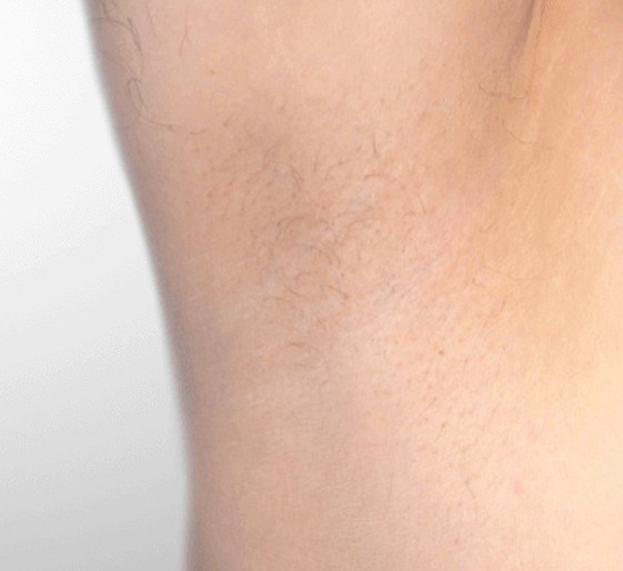 Underarm Hair Removal — after