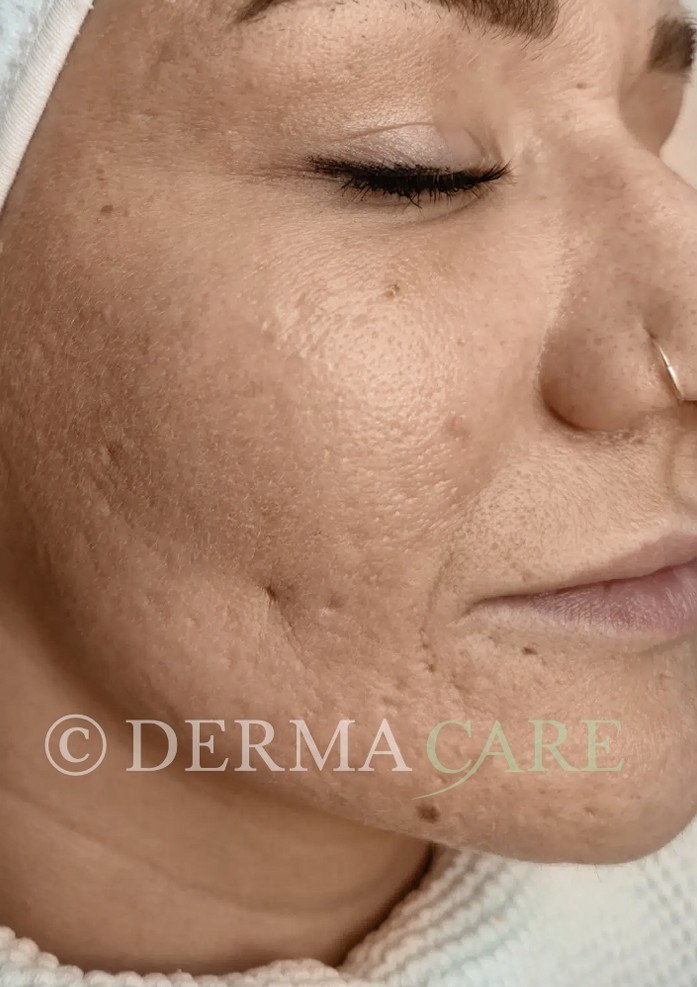 Acne TCA Peel — after