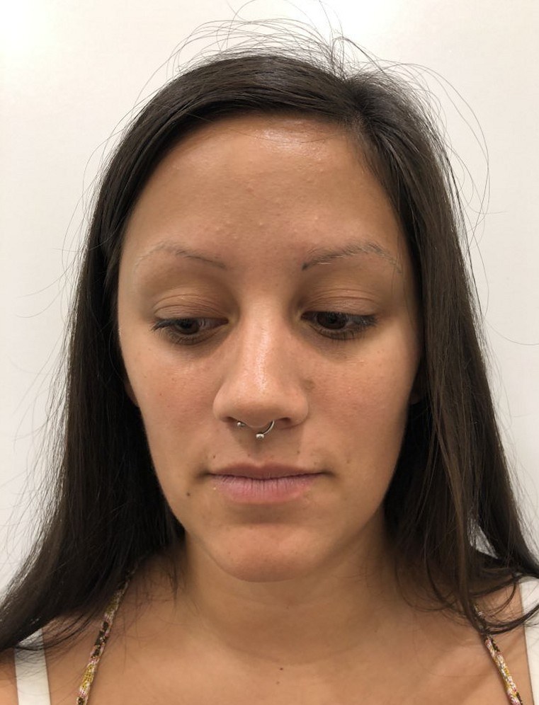 Eyebrows before and after 2 treatments — after