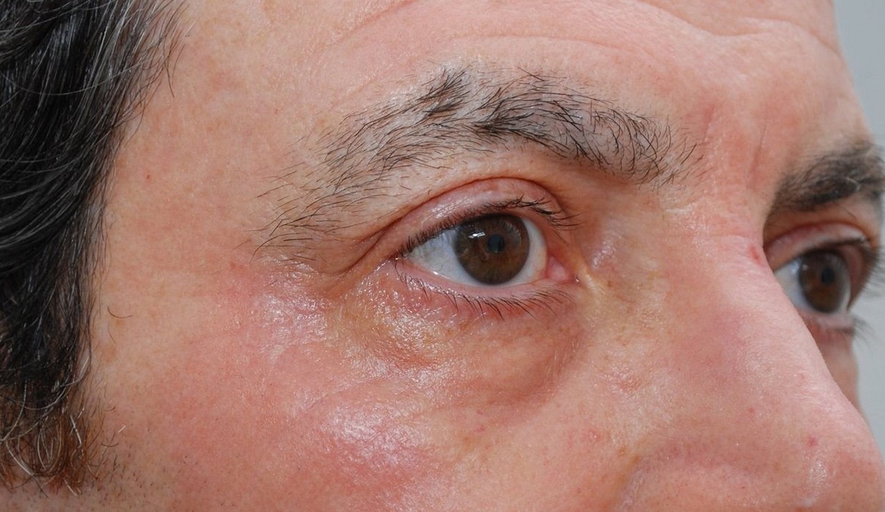 Treating Eye Wrinkles with Laser — after