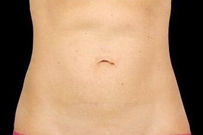Abdomen Treatment, Woman — after
